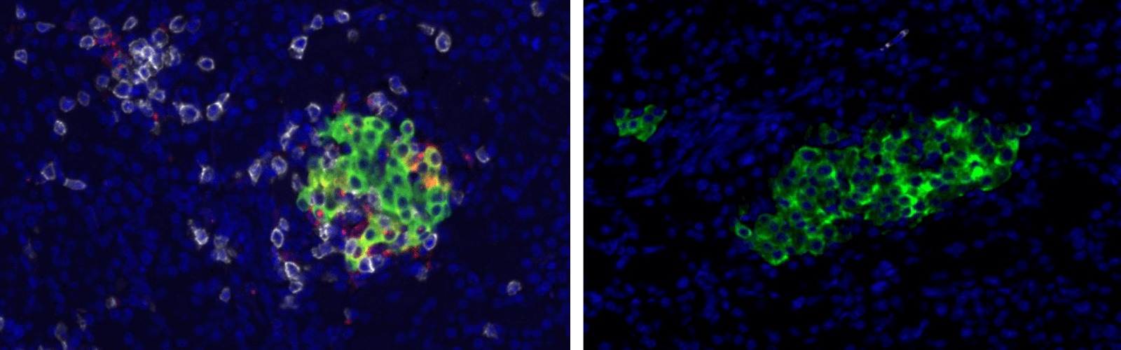 insulitis islet with T cell infiltration 