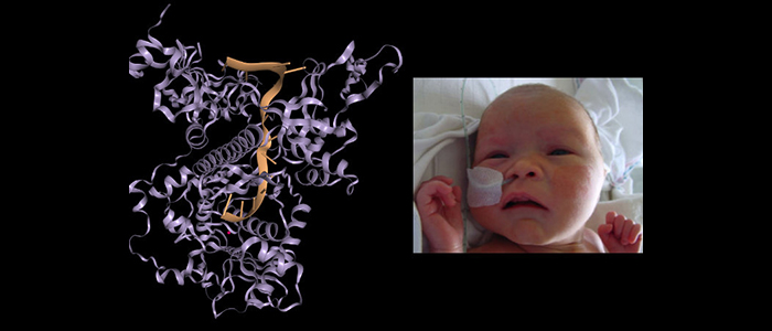  On the left, a three-dimensional structure of the protein DIS3L2 in purple interacting with RNA in orange; on the right, a photo of a newborn in the hospital.