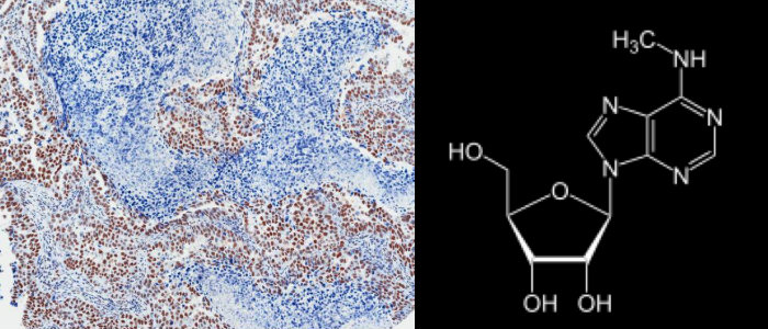  Two-part image showing immunohistochemistry staining of a tumor on the left and a chemical structure on the right.