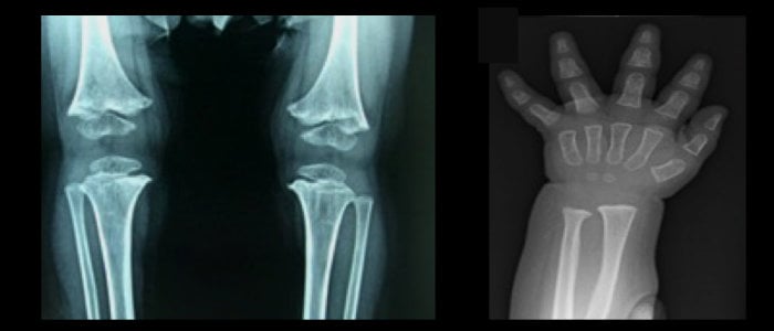  X-ray images showing a child's knee joint on the left and a child's hand on the right.