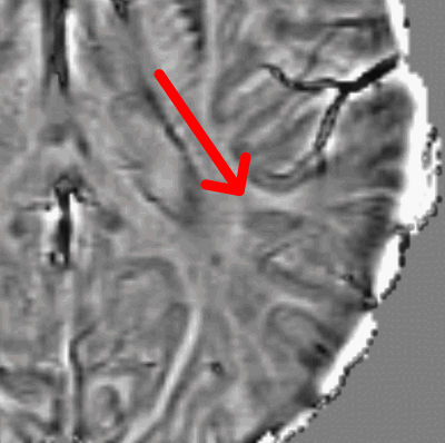 Animation of a paramagnetic rim lesion