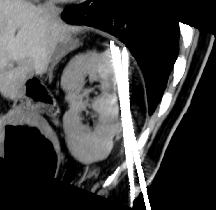 Renal Upper Pole Ablations