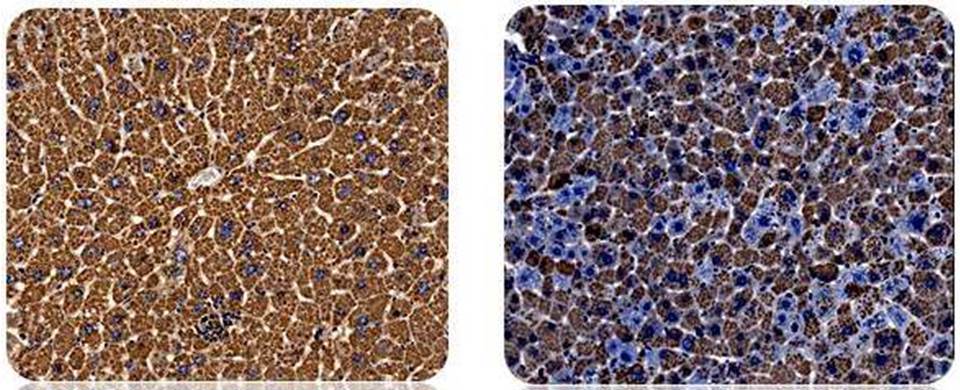 AAT silencing liver AAT silencing liver