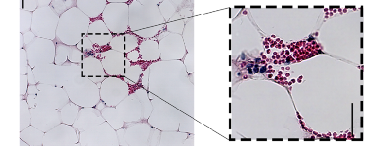 Diabetes Bone Marrow Research Study