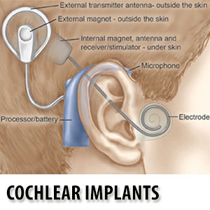 Cochlear implants