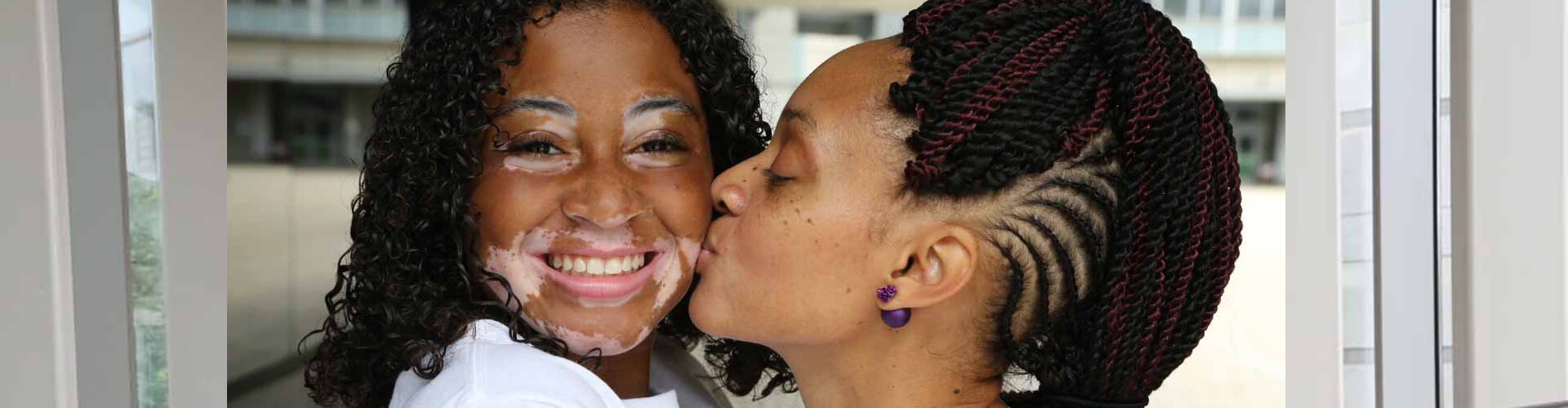 Vitiligo Clinical Trials