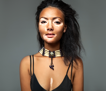 New treatment in the works for disfiguring skin disease,&nbsp;vitiligo