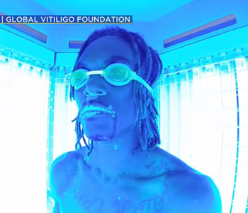 New Treatment Can Reverse Effects Of&nbsp;Vitiligo